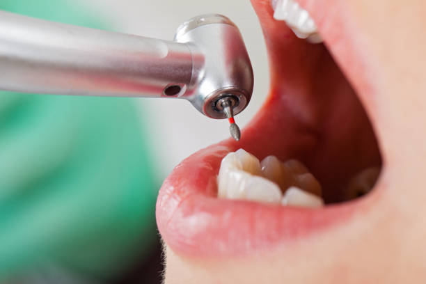 Best Emergency Dental Extractions in Graysville, AL